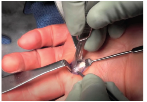 Trigger finger surgery image